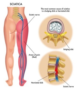 Sciatica caused by a bulging vertebral disc - AKA pain.